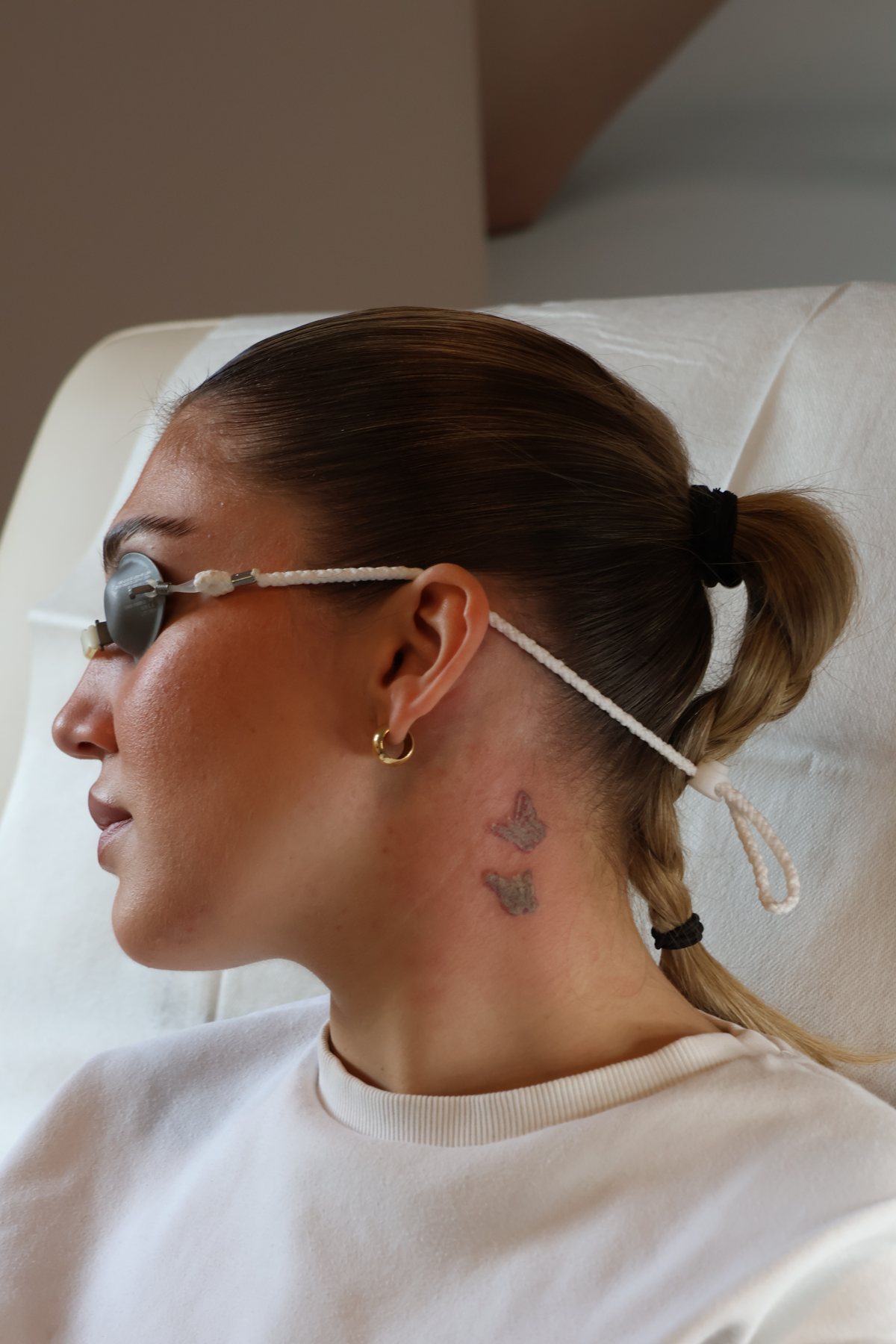 Tattooentfernung Bad Homburg - Praxis D.: Haut direkt nach der Lasersitzung